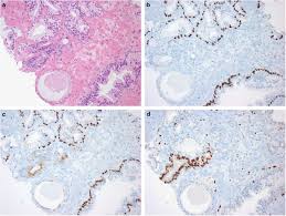 Two new figures have been included. Prostate Cancer Diagnostic Criteria And Role Of Immunohistochemistry Modern Pathology