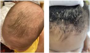 Image result for dry scabs on the head in children