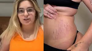 Antes x Depois: Viih Tube mostra resultado de procedimento estético para  tratar estrias - Metropolitana FM