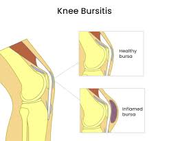 Image result for Prepatellar Bursitis