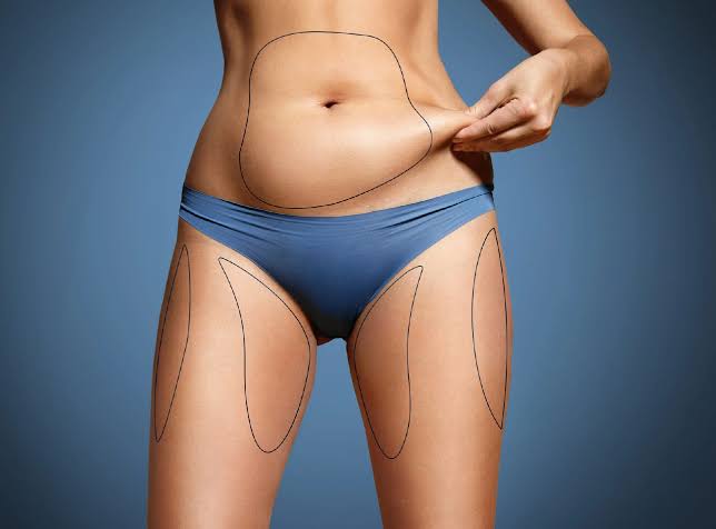 Combined Tummy Tuck & Liposuction For Body Contouring - Perfect Doctors  Clinic