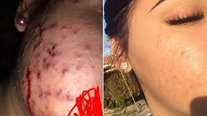 One sign concerning to what extent teenagers will deal with skin break out is their own particular involvement with past pimples. Teen Says Green Tea And Honey Cleared Cystic Acne Before And After Photos Allure