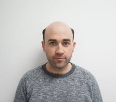 HAIR4ALL CLIENT BEFORE