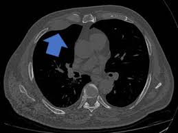 Infiltration of the extrapleural fat plane obvious direct . Insert The Dark Side Of Mesothelioma Sciencedirect