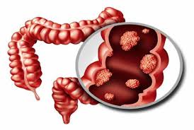 Image result for Constipation in Cancer