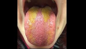 Image result for yellow tongue infection