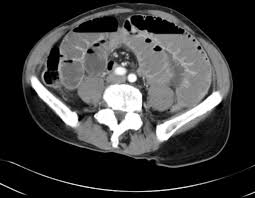 Image result for CT Intravenous Contrast