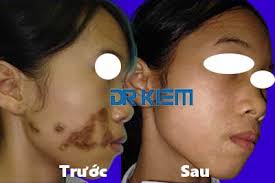 Điều trị bớt cà phê bằng laser Pico