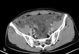 Reasons for a prostate gland ct scan: Epos Trade
