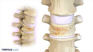 They each consist of an anterior vertebral body, and the vertebral body forms the anterior part of each vertebrae. Osteoporosis The Primary Cause Of Collapsed Vertebrae