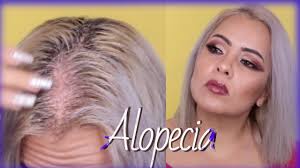 On the contrary, if the itching is mild and you don't have any scalp injuries, you'll have no problem dyeing your hair. Severe Scalp Chemically Burned How To Heal The Scalp After Bleached Your Hair It Work Youtube