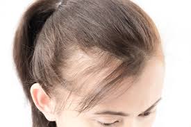But some women experience hair loss. Female Hair Thinning After Pregnancy Fue Hair Doctor