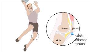 What can i do to get rid of patellar tendonitis(jumper's knee)? answered by dr. Patella Tendinopathy The 4 Stage Management Program For Jumper S Knee Rayner Smale