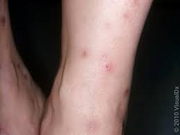 Image result for flea bites