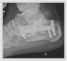 Calcaneus Fracture Recovery Walking After A Calcaneal Fracture Surgery Calcaneus Fracture Stress Fracture Fractures