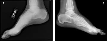 L'arthropathie de charcot entraîne une destruction progressive des os et des tissus mous au l'arthropathie de charcot peut survenir à n'importe quelle articulation; Charcot Foot Clinical Clues Diagnostic Strategies And Treatment Principles American Family Physician