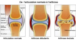 Arthrose ist eine degenerative erkrankung der gelenke, die zu einem zunehmenden abbau des knorpels und zur schädigung des gelenknahen knochens und der gelenkkapsel führt. L Arthrose Maladie Evolutive Technihorse Le Blog