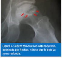 Osteonecrosis de Cadera - AAHKS