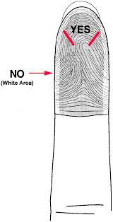 Image result for Capillary Puncture