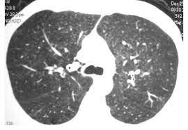 Respiratory bronchiolitis ild (rbild) and desquamative interstitial pneumonia (dip). Rb Ild In A 48 Year Old Male Smoker Who Presented With Dyspnea And Download Scientific Diagram
