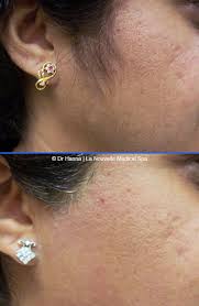 Here is our guide to 10 facts you need to know before laser hair removal. Laser Hair Removal Before And After Photos Oxnard Ventura