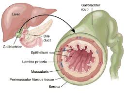 Gallbladder Cancer Stages