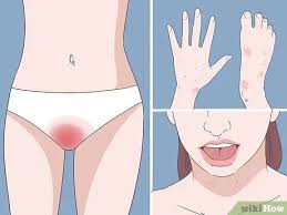 Learn about online treatment with wisp prescription meds & over the counter remedies, discreetly packaged, for pickup or free delivery. 4 Ways To Diagnose A Yeast Infection At Home Wikihow