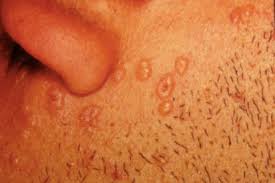 Image result for chickenpox