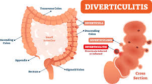 Image result for Diverticulitis