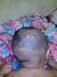 Yang perlu diperhatikan untuk mengatasi bisul pada kepala bayi. Oh Media Kepala Ank Sy Keluar Biji2 Mcm Bisul Penuh Facebook