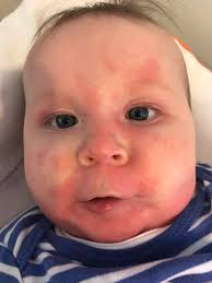 Im in er should a boiled egg cause a reaction ?