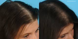 Biotin Before And After Hair Hair Loss Is Not Only Disease But Also Loose Your Confidence So Get Your Hair Back With Best Hairtransplant Clinic In United States With Qlook