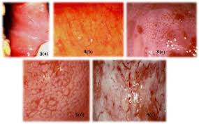 Image result for Colposcopy Findings