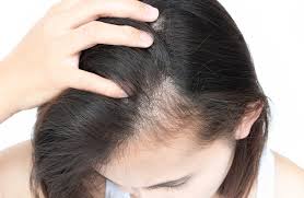 Image result for Alopecia