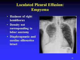 Surgical thoracostomy tube placement and radiologically guided catheter drainage are standard therapy for loculated pleural fluid collections. What Is Loculated Pleural Effusion Loculated Right Pleural Effusion With Pleural Enhancement Pleural Effusions Compromise Lung Function By Preventing Its Kumpulan Alamat Grapari Telkomsel Dan Alamat Bank