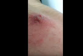 Why do i get so bloated during and after my period? Popping Ingrown Hair Infection On The Back New Pimple Popping Videos