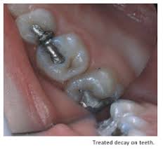 Sealing grout with an applicator. Dental Sealants Oral Health Health Senior Services