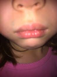 She was eating regular hard cat i started reading around about the commercial foods causing allergic reactions. Swollen Lip Allergy Drone Fest