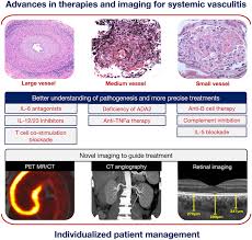 The symptoms of anug are usually more severe than those of gum disease and can include: Advances In Therapies And Imaging For Systemic Vasculitis Arteriosclerosis Thrombosis And Vascular Biology