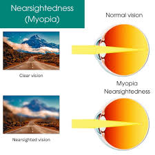 Image result for Myopia