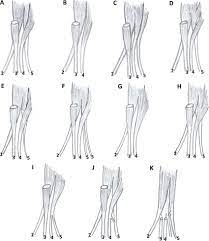 Strong tendon repair required.four strand core suture adelaide repair with circumferential epitendinous suture fdp. Fds 5 Variations Muscle A Normal B Absent C Unusual D Download Scientific Diagram