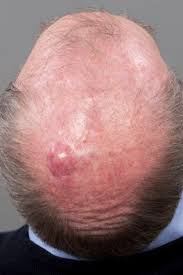 Lymphoma can sometimes cause an itchy rash. Lymphoma Action Skin Lymphoma