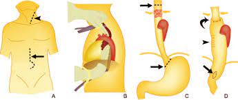 Compare quotes for mckeown procedure at top hospitals and book an instant appointment on credihealth. Drawings Illustrate Transhiatal Esophagectomy Without A Thoracotomy In Download Scientific Diagram