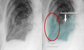 Image result for Pulmonary Contusion