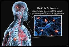 Sclerosi multipla e sclerosi a placche. Sclerosi Multipla Conoscere L Evoluzione Della Malattia