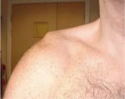 A lump on the collarbone can have many causes, some of which may require medical attention. Collar Bone Pain Physiotherapy