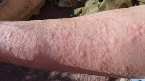 Hives Causes Risks Prevention And Pictures