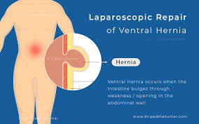 Image result for Hernia Reduction