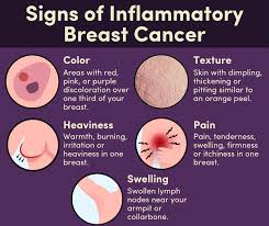 Image result for Inflammatory breast cancer