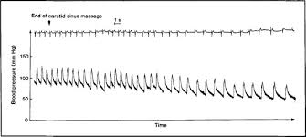 Carotid Sinus Syndrome And Wrestling Mayo Clinic Proceedings